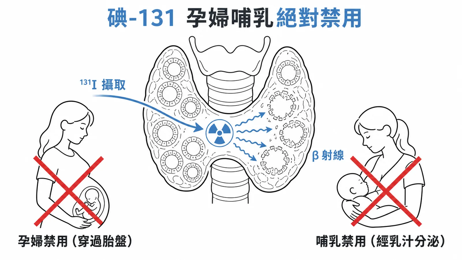 碘-131 孕婦哺乳絕對禁用示意圖