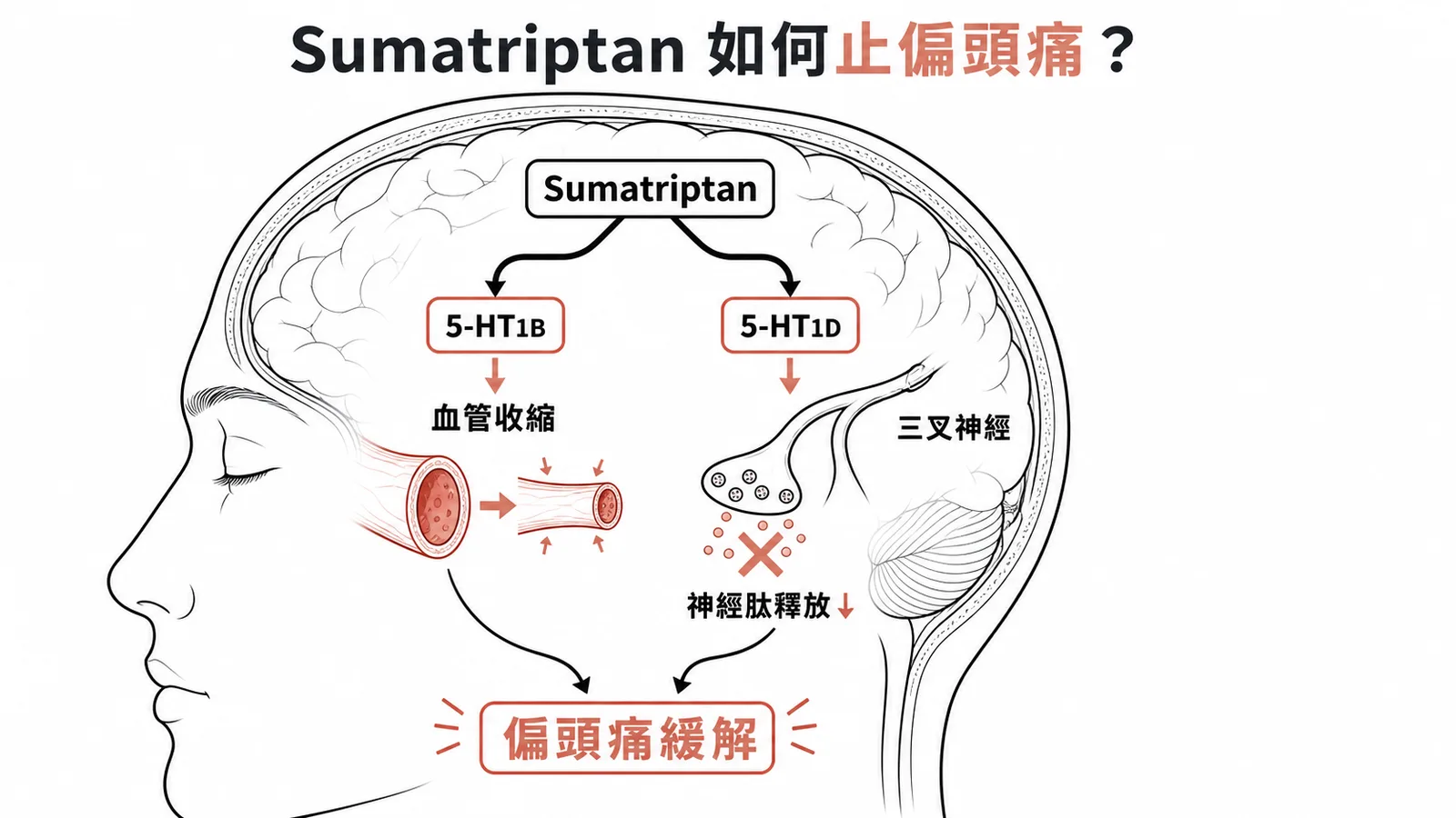 Sumatriptan 雙機轉：5-HT1B 收縮血管 + 5-HT1D 抑制三叉神經肽釋放，緩解偏頭痛