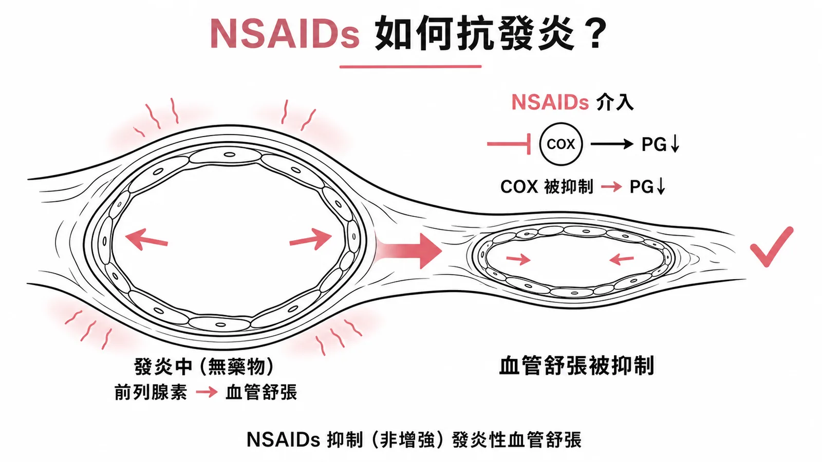 NSAIDs 抑制 COX 減少前列腺素，進而抑制（非增強）發炎性血管舒張