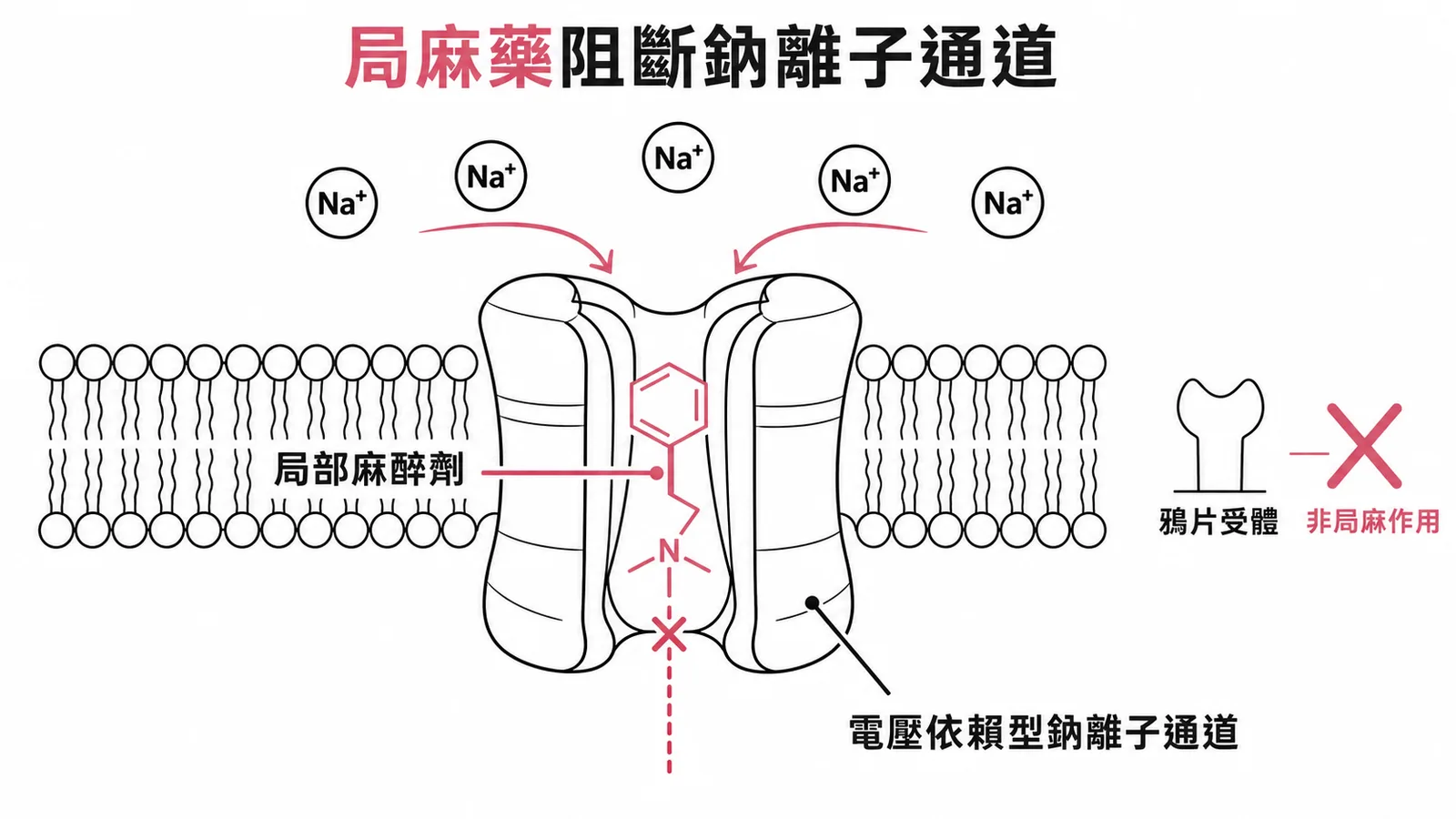 局部麻醉劑阻斷鈉離子通道而非鴉片受體的機轉示意圖