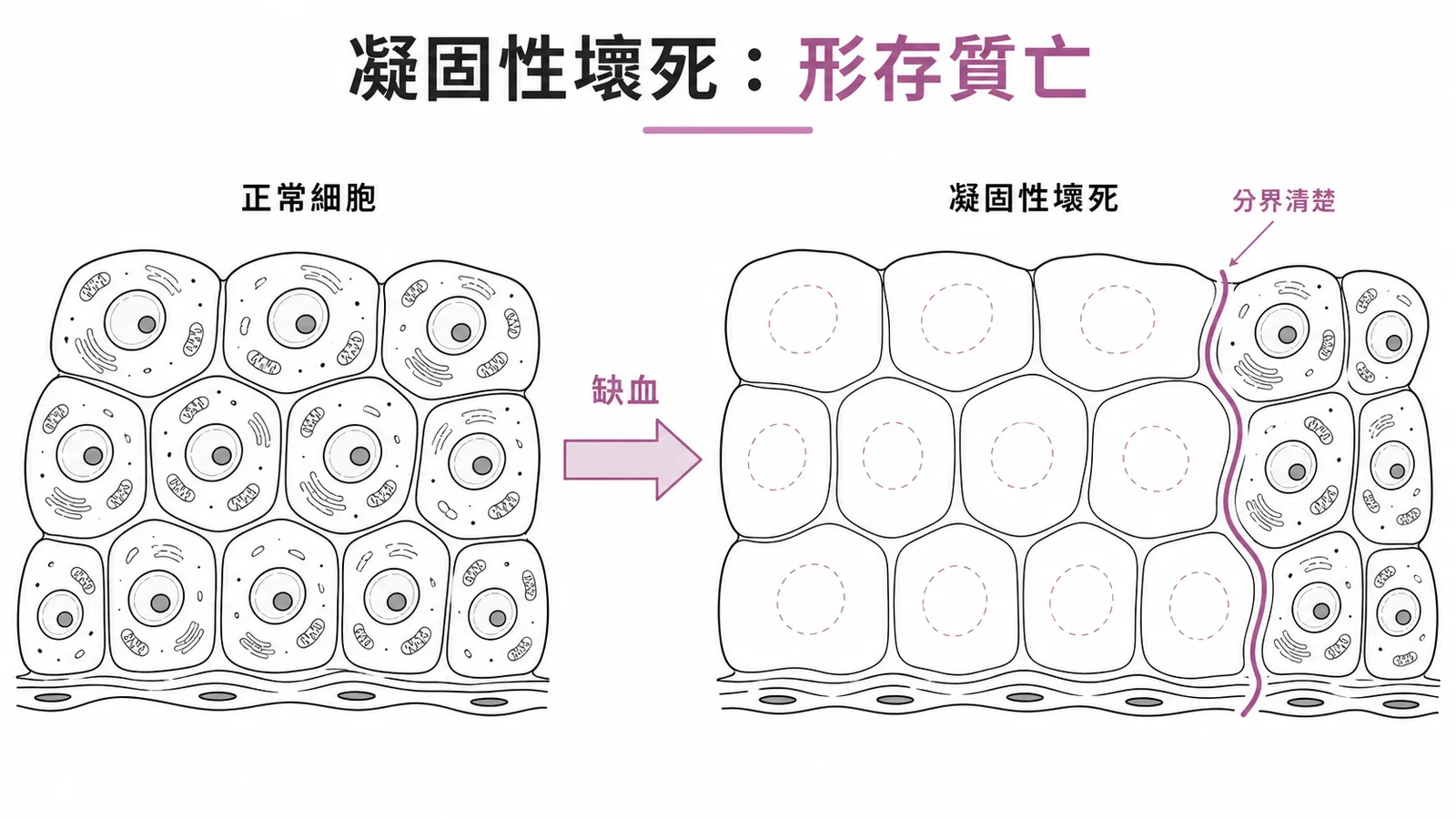 凝固性壞死的正常細胞與壞死細胞對照圖，外形完整但內部結構消失