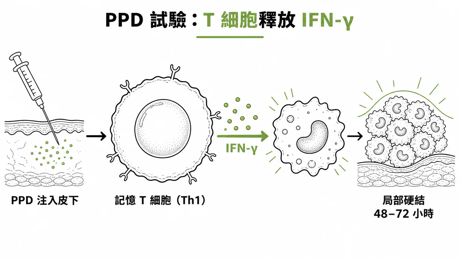 PPD 試驗中 T 細胞釋放 IFN-γ 活化巨噬細胞形成硬結的免疫流程圖