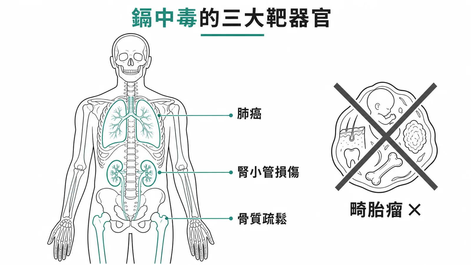 鎘中毒三大靶器官（肺、腎、骨）與畸胎瘤無關的人體示意圖