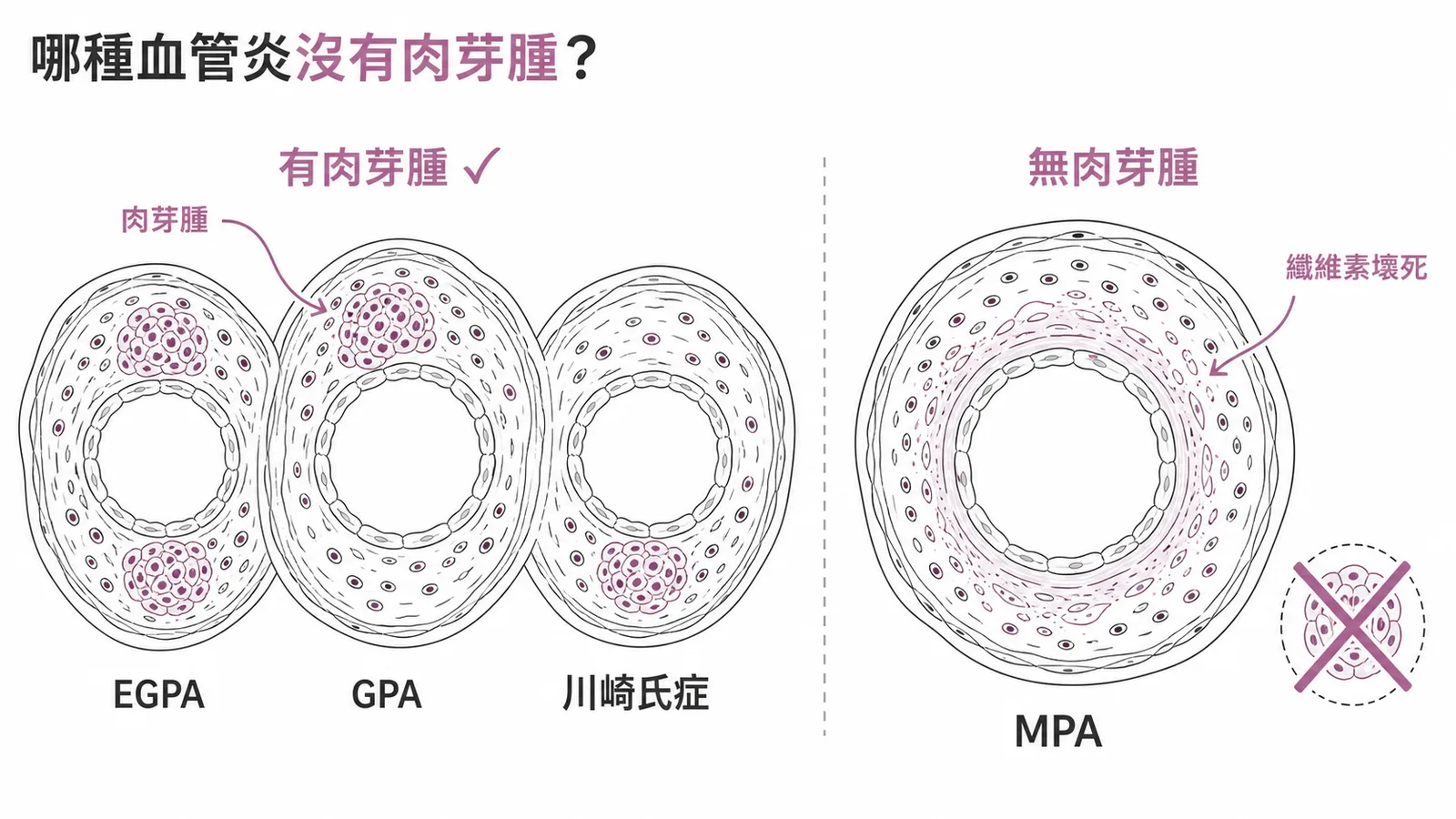 血管炎肉芽腫對照：EGPA、GPA、川崎氏症有肉芽腫，MPA無肉芽腫只有壞死性發炎
