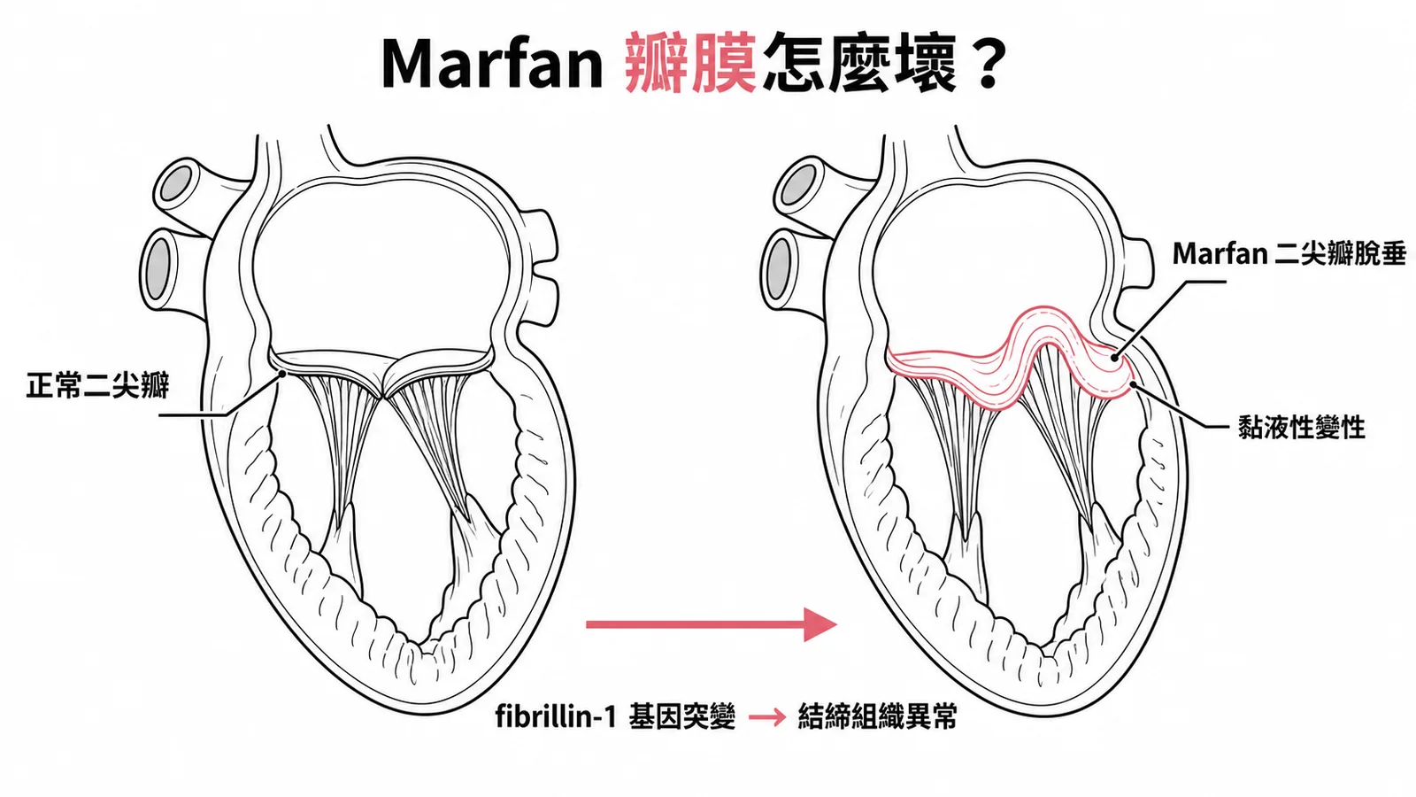 Marfan症候群二尖瓣脫垂：fibrillin-1突變導致黏液性變性，瓣膜鬆弛脫垂