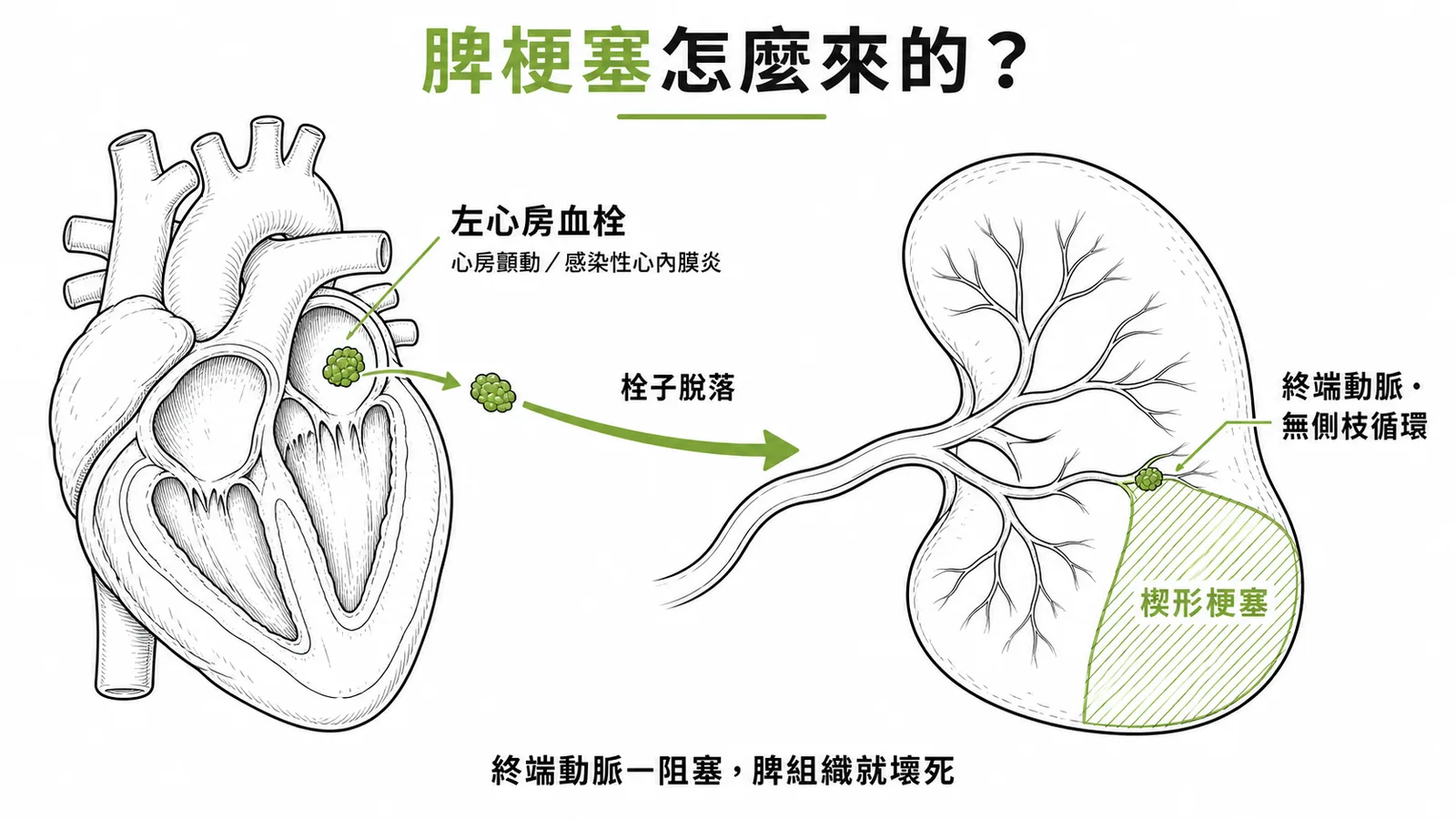 脾梗塞機制：心臟栓子經終端動脈阻塞脾臟造成楔形梗塞