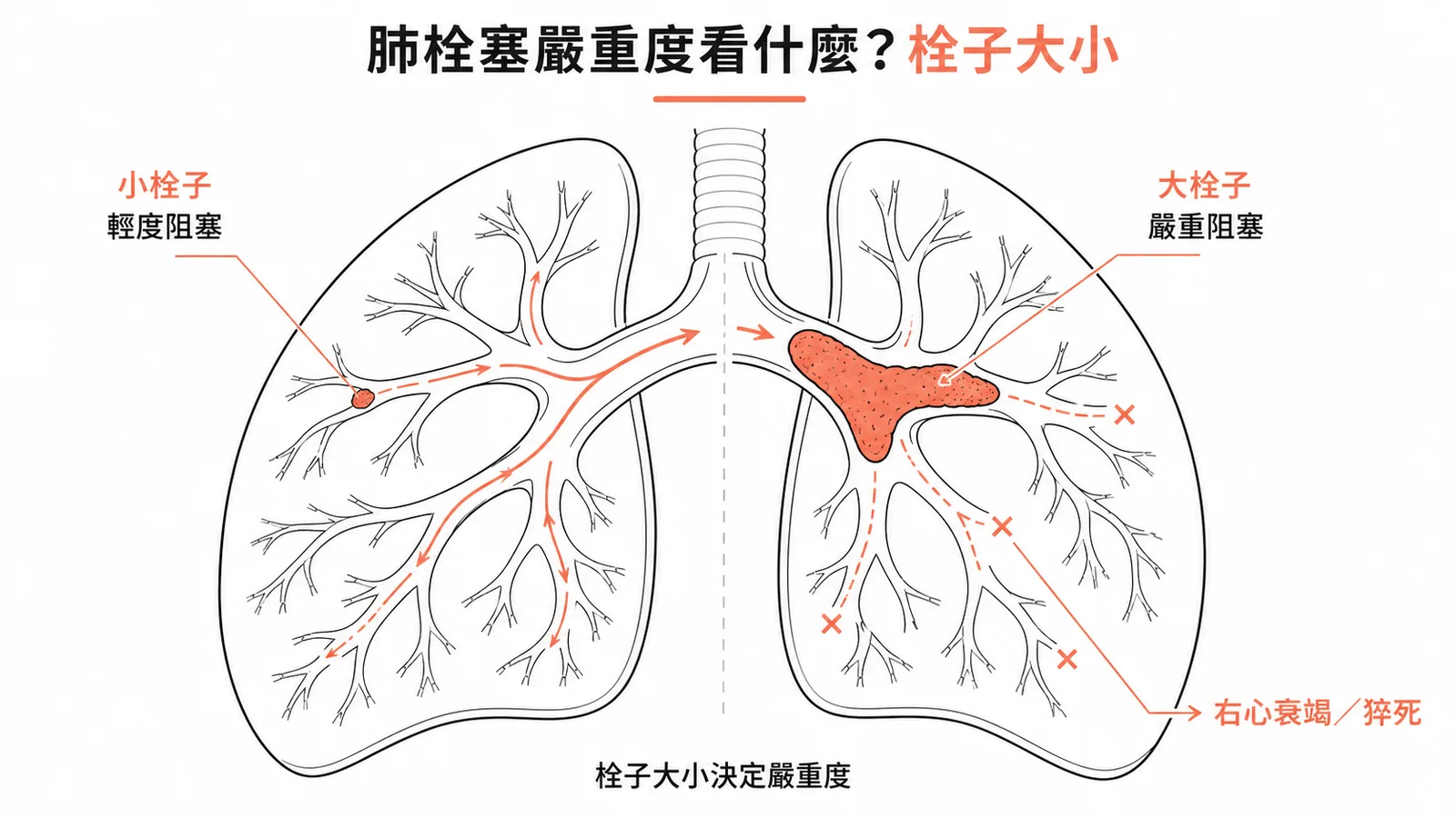 肺栓塞嚴重度由栓子大小決定：小栓子輕度阻塞vs大栓子嚴重阻塞致右心衰竭