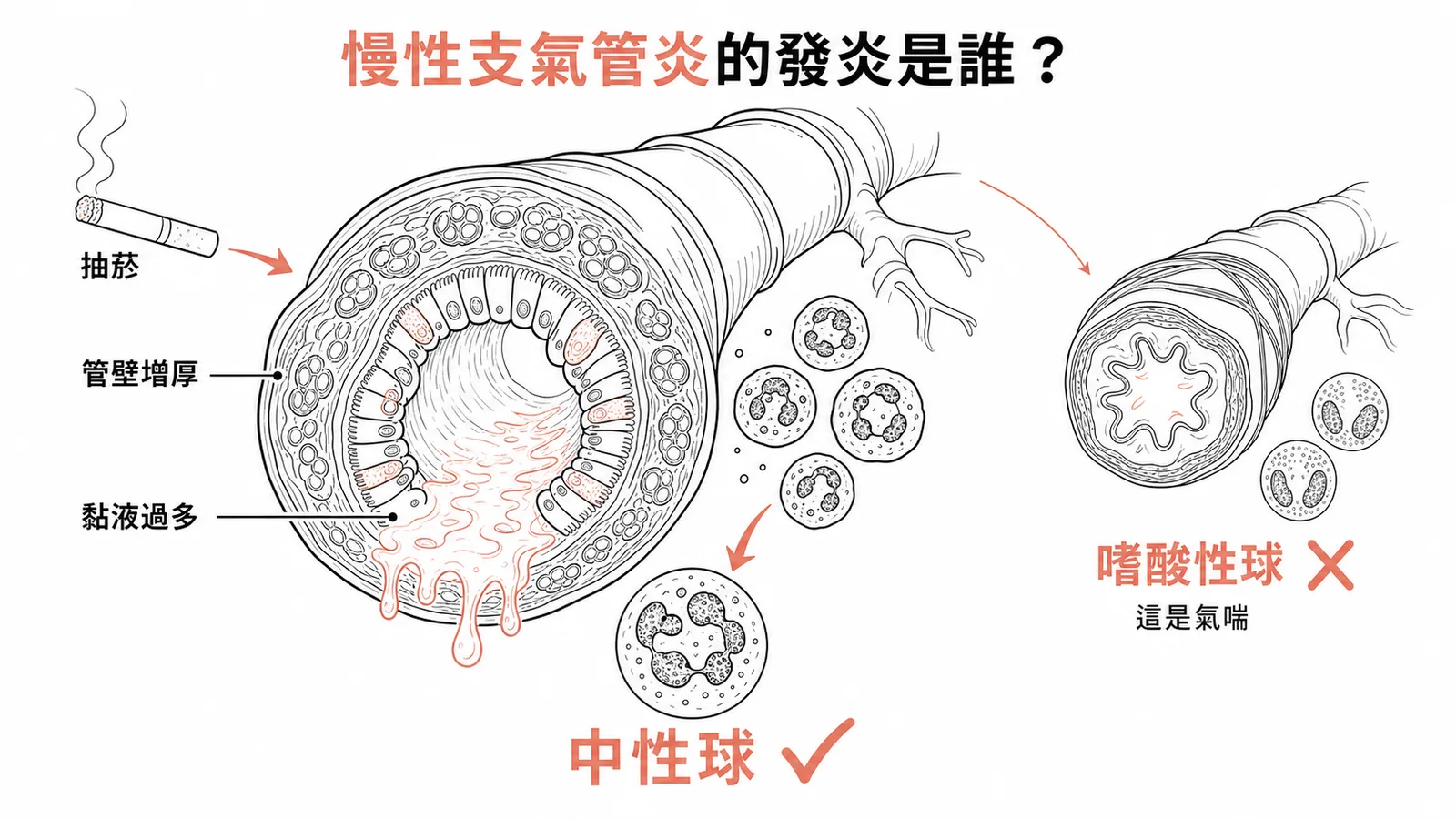 慢性支氣管炎發炎以中性球為主，嗜酸性球是氣喘的特徵