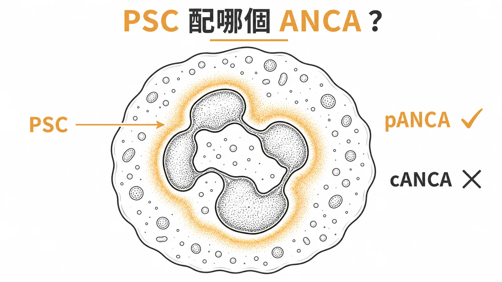 PSC配pANCA不是cANCA：中性球核周型螢光才是PSC的血清指標