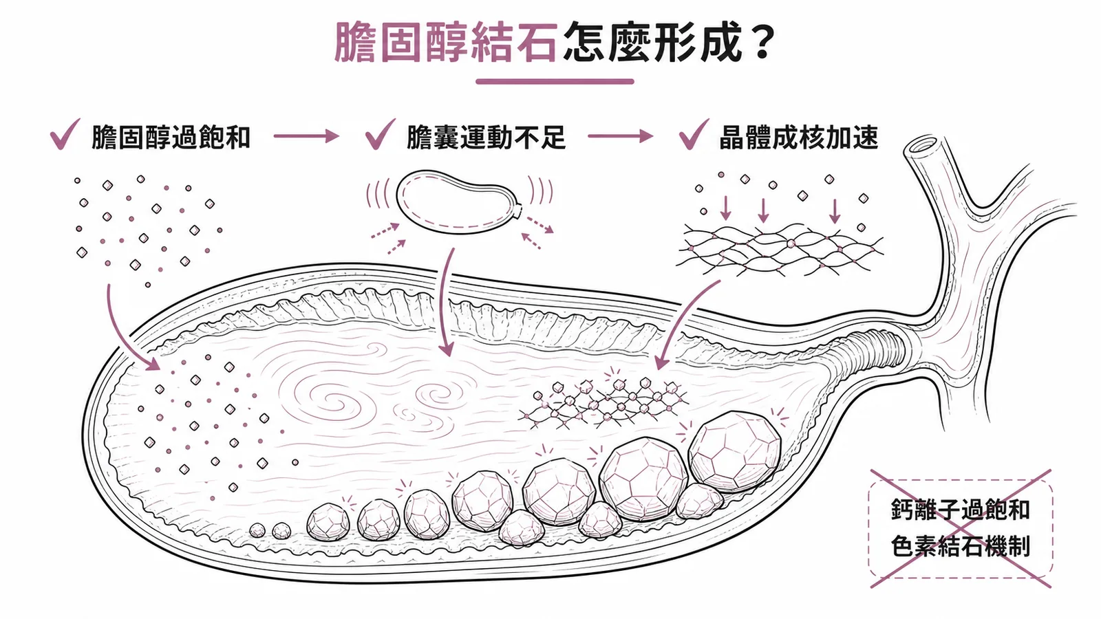膽固醇結石三大成因：膽固醇過飽和、膽囊運動不足、晶體成核加速；鈣離子過飽和是色素結石