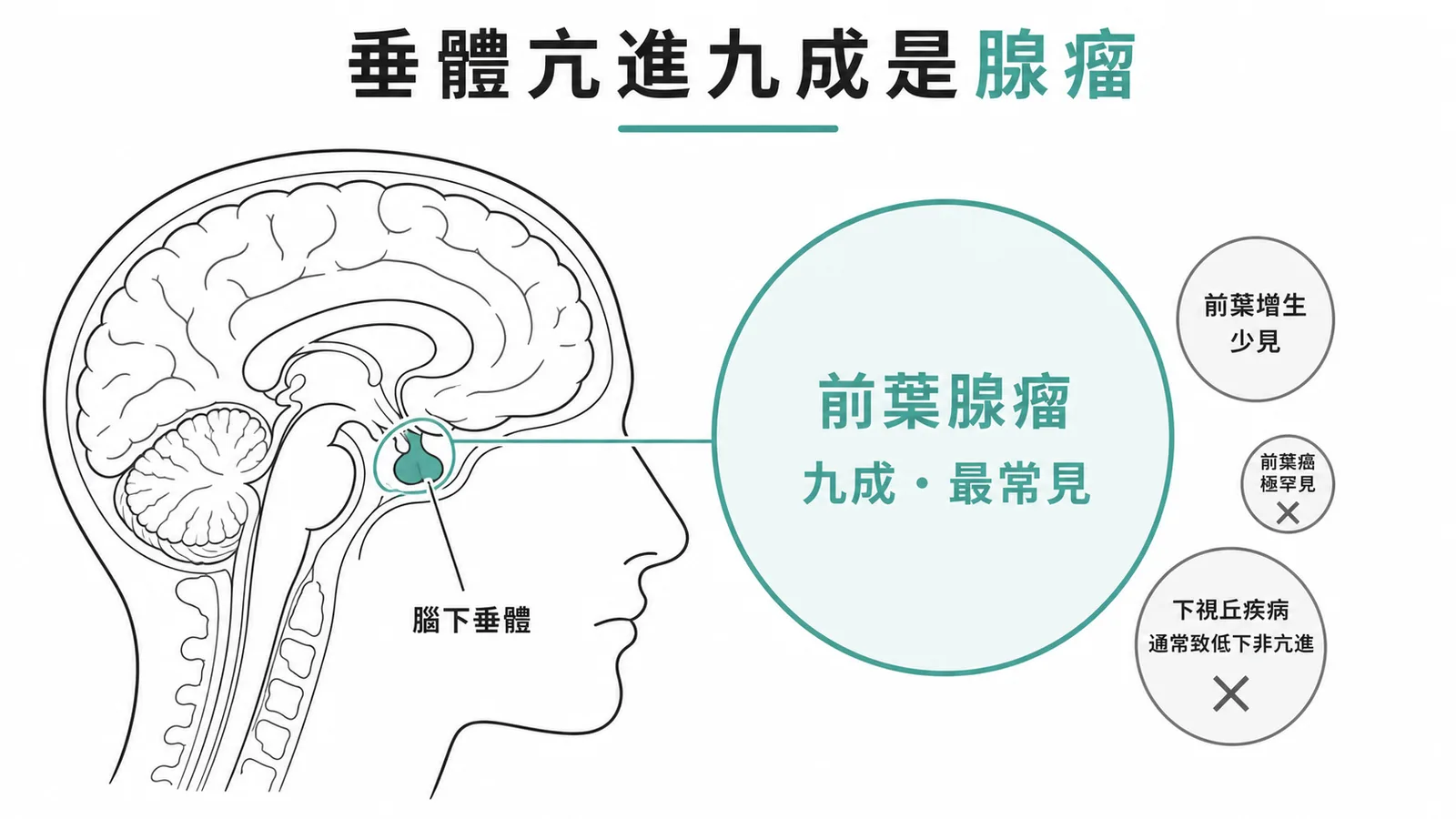 垂體亢進九成是腺瘤：前葉腺瘤為最常見原因