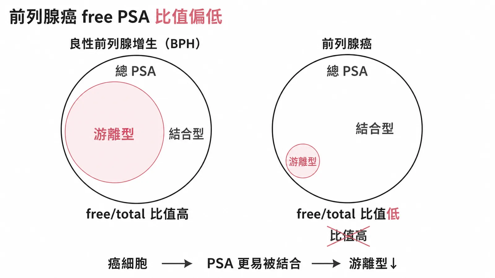 前列腺癌free PSA比值偏低：癌細胞使PSA更易被結合