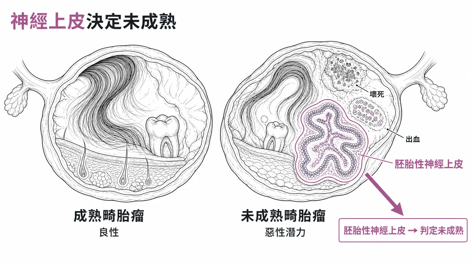 神經上皮決定未成熟：成熟與未成熟畸胎瘤對比