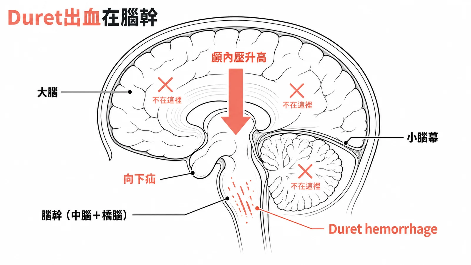 Duret出血在腦幹：腦疝壓迫穿通血管破裂