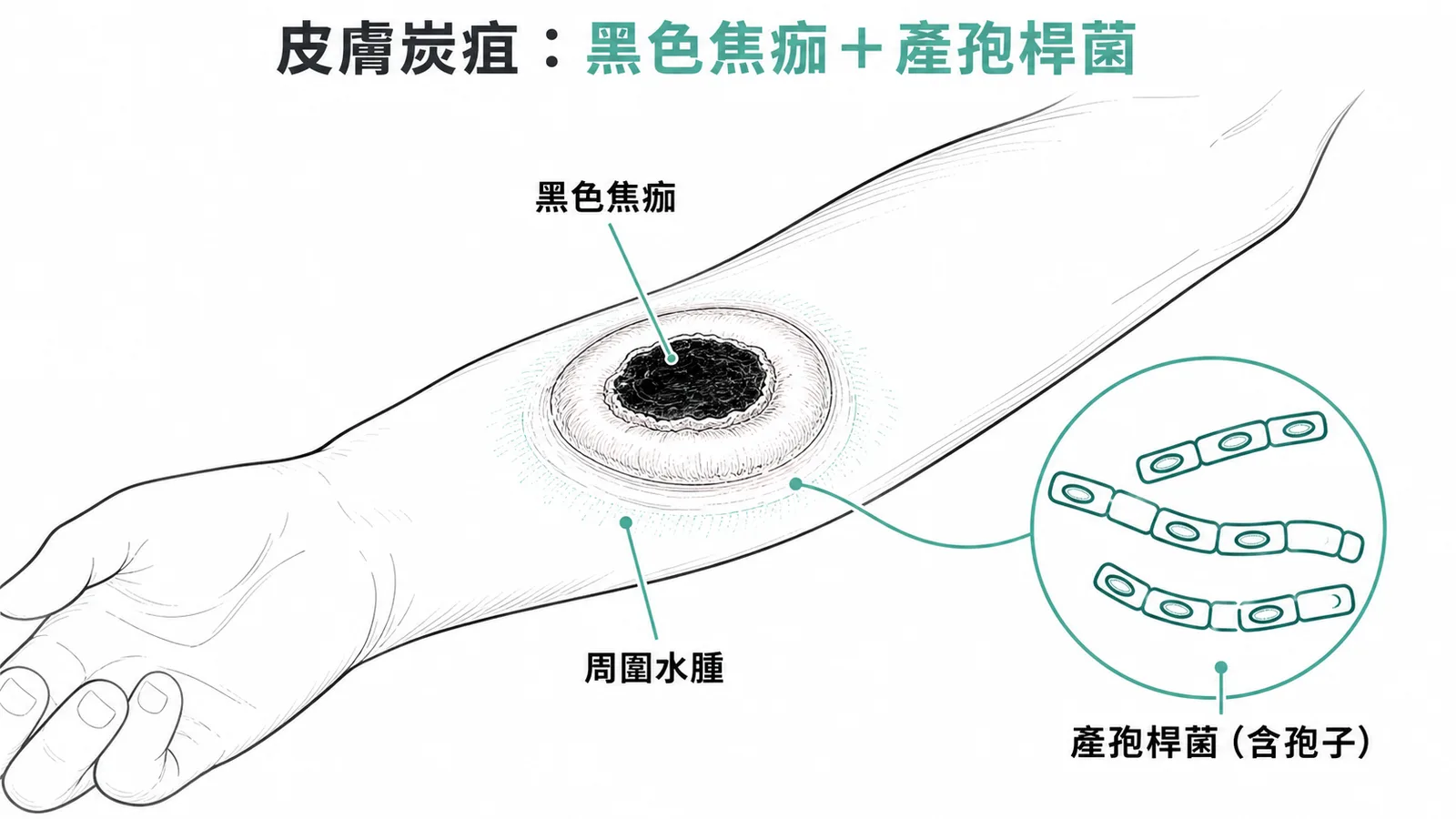 皮膚炭疽典型病灶:手臂黑色焦痂周圍水腫與產孢桿菌示意