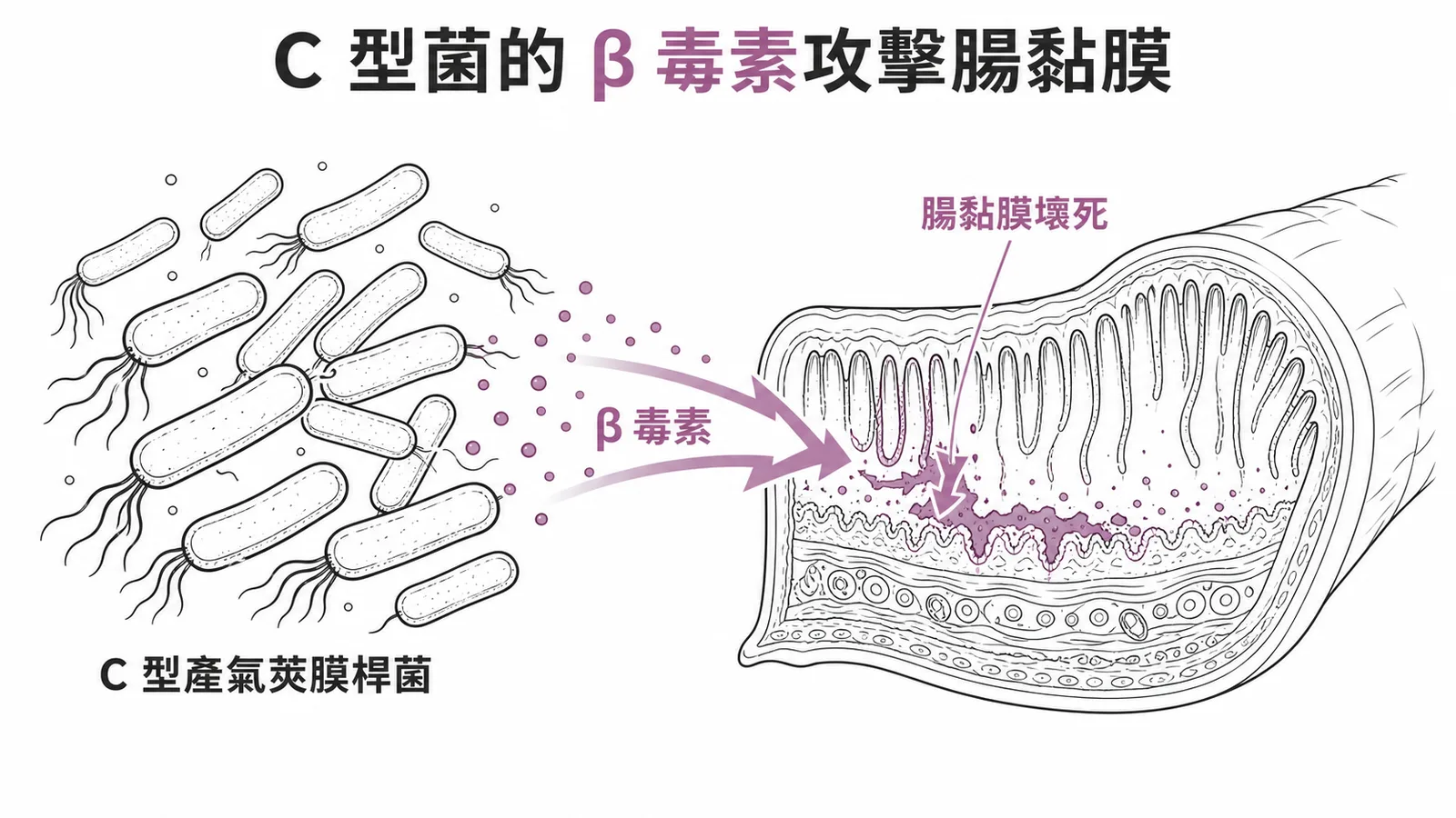 C型產氣莢膜桿菌β毒素攻擊腸黏膜造成壞死