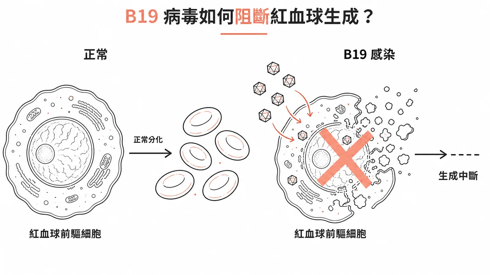 B19病毒入侵紅血球前驅細胞導致溶解、阻斷紅血球生成的對照示意圖