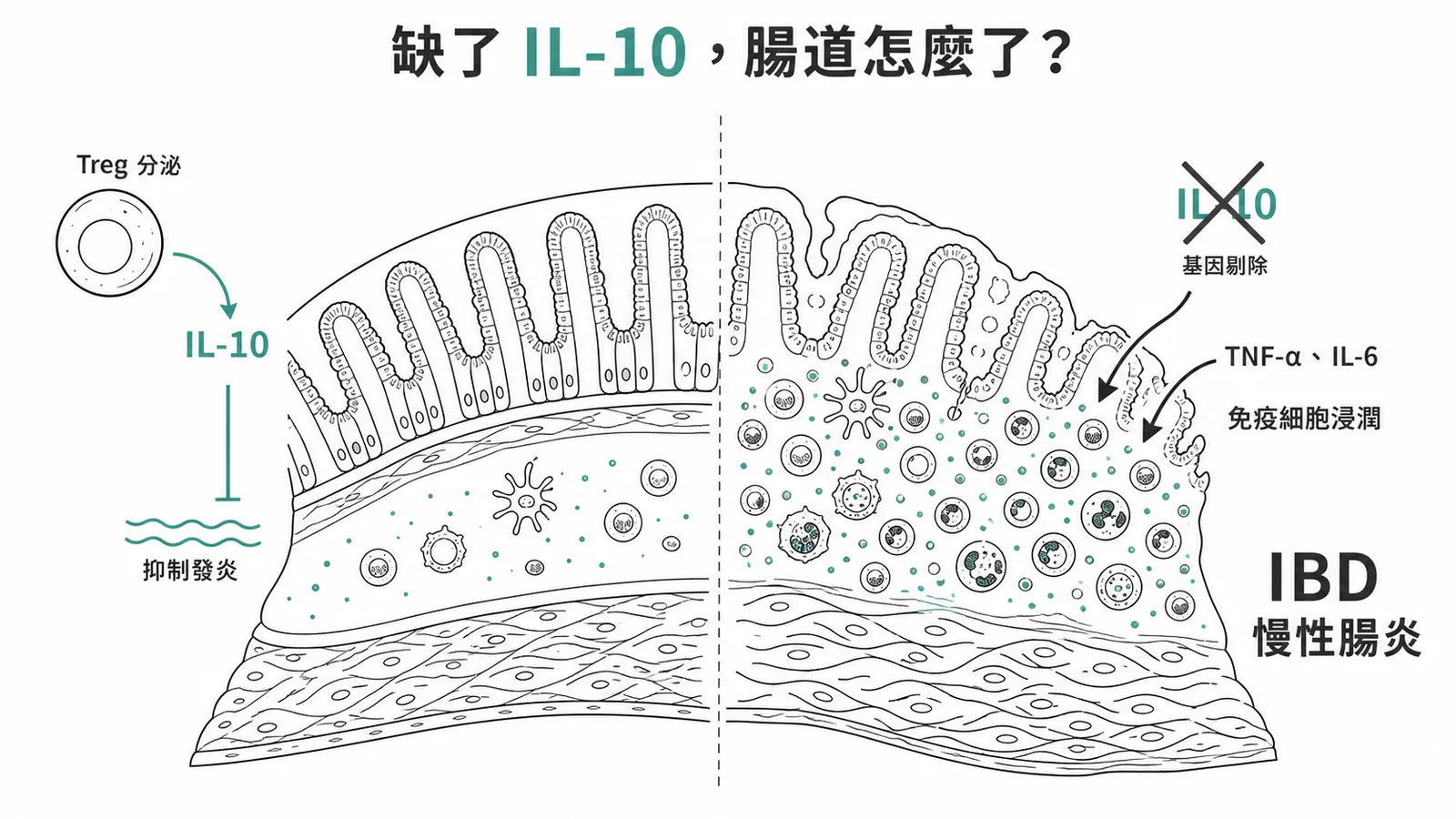 IL-10 基因剔除後腸道免疫失控引發 IBD 慢性腸炎的機轉對照圖