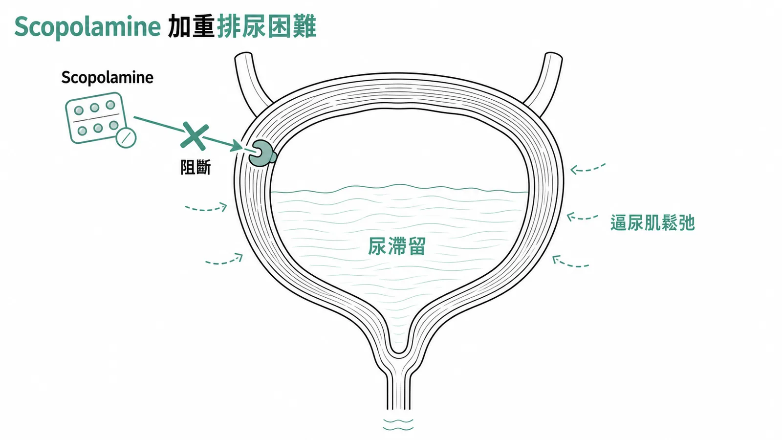 Scopolamine阻斷muscarinic受體致膀胱逼尿肌鬆弛加重尿滯留