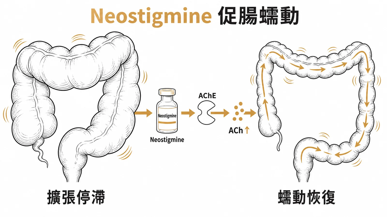 Neostigmine抑制AChE增加ACh刺激結腸蠕動治療假性阻塞