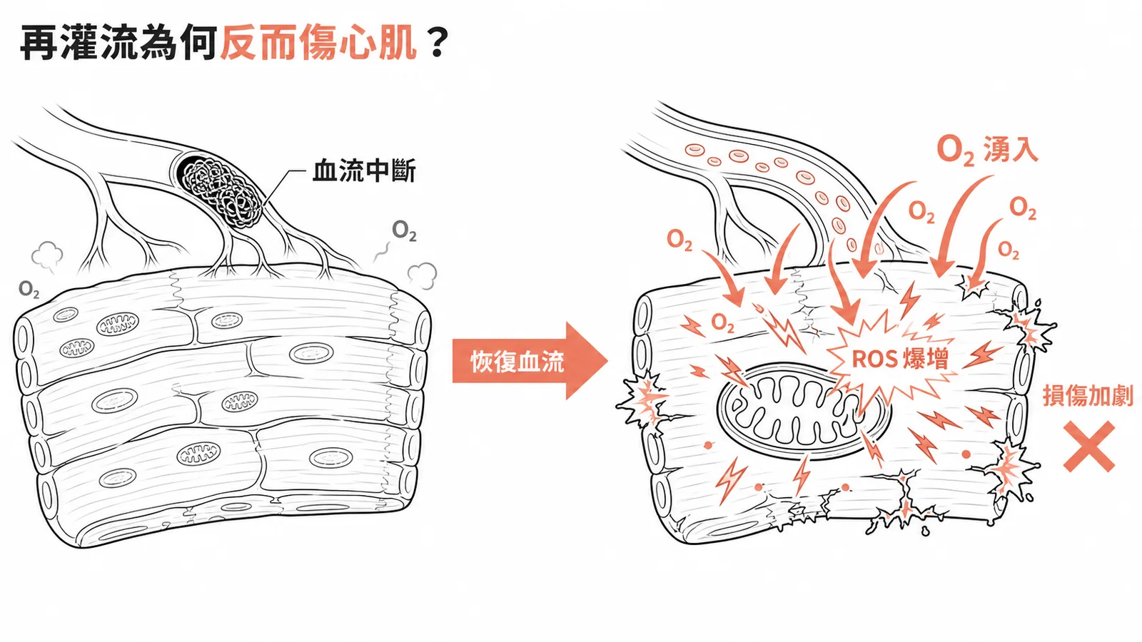 心肌再灌流損傷與自由基產生機轉圖