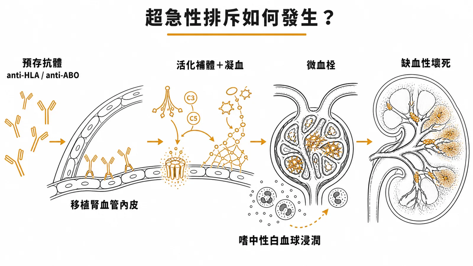 腎移植超急性排斥機轉流程圖