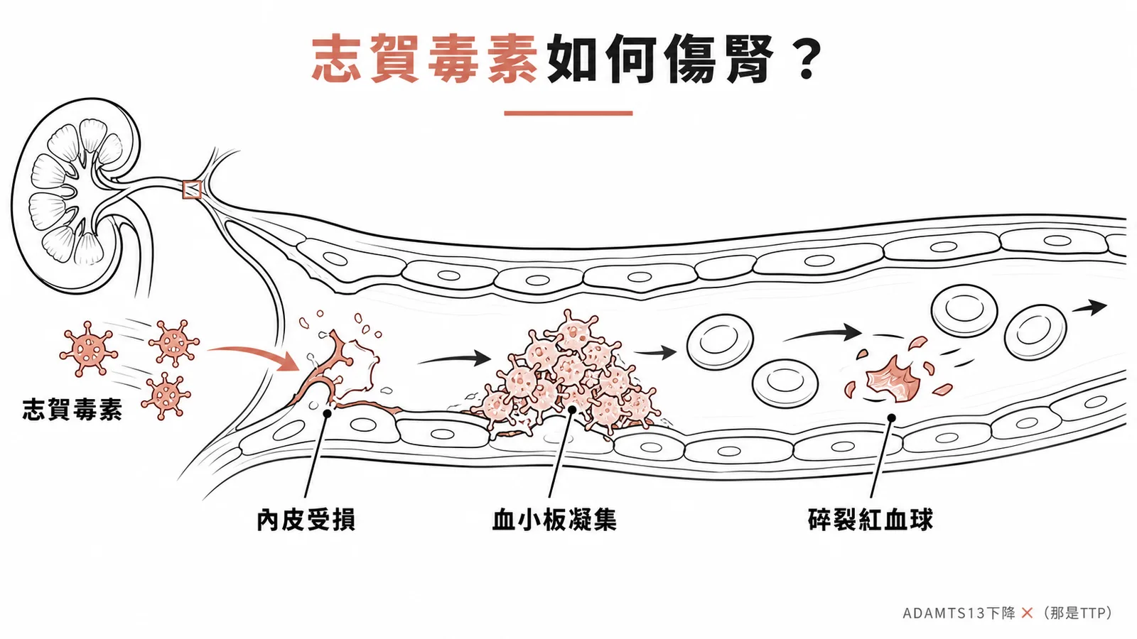 志賀毒素損害腎臟微血管內皮引起HUS的機轉示意圖