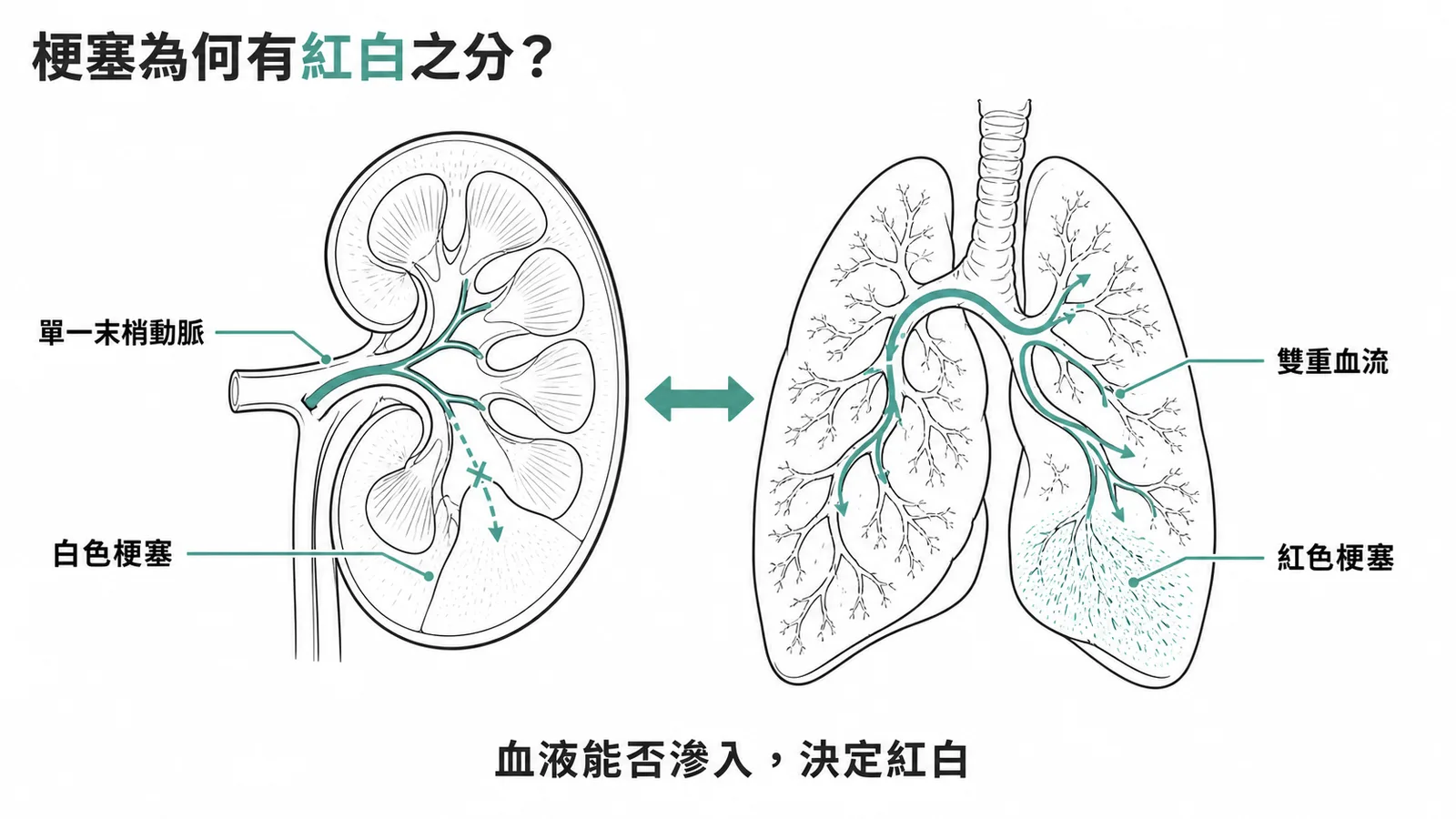 白色梗塞與紅色梗塞的差異對照圖