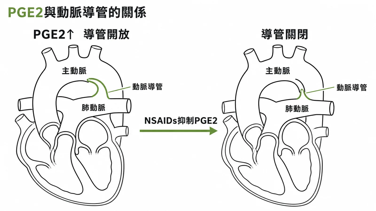PGE2維持動脈導管開放與NSAIDs促使關閉的示意圖