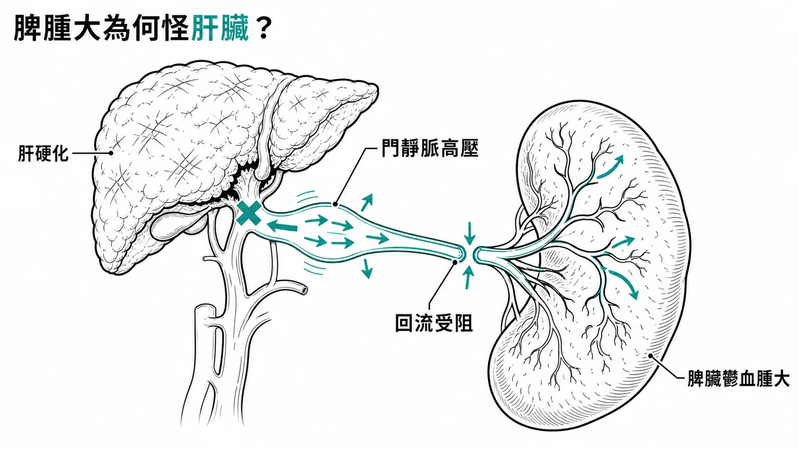 肝硬化導致門靜脈高壓引起鬱血性脾腫大的示意圖