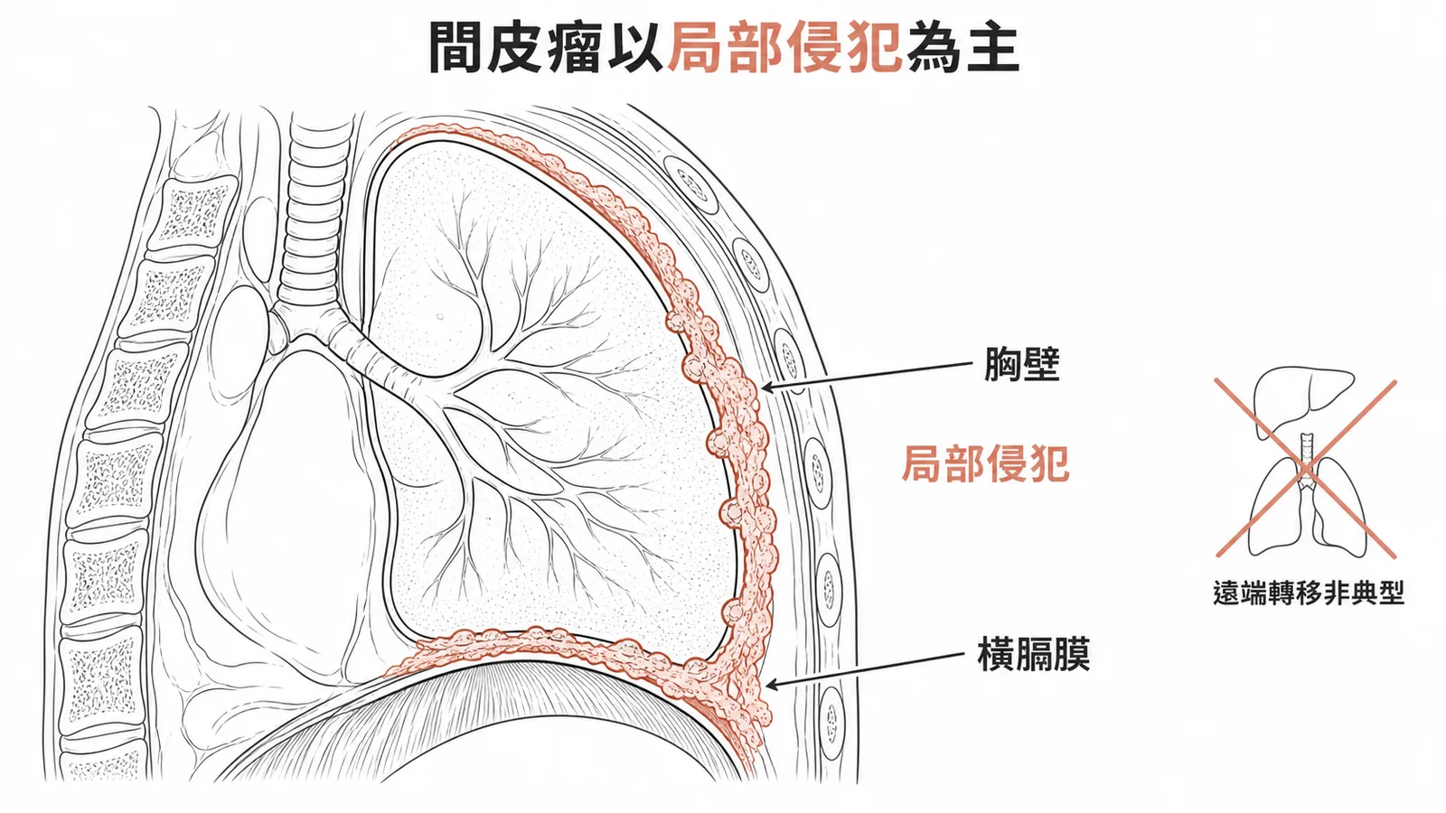 惡性間皮瘤沿胸膜局部侵犯而非遠端轉移的示意圖