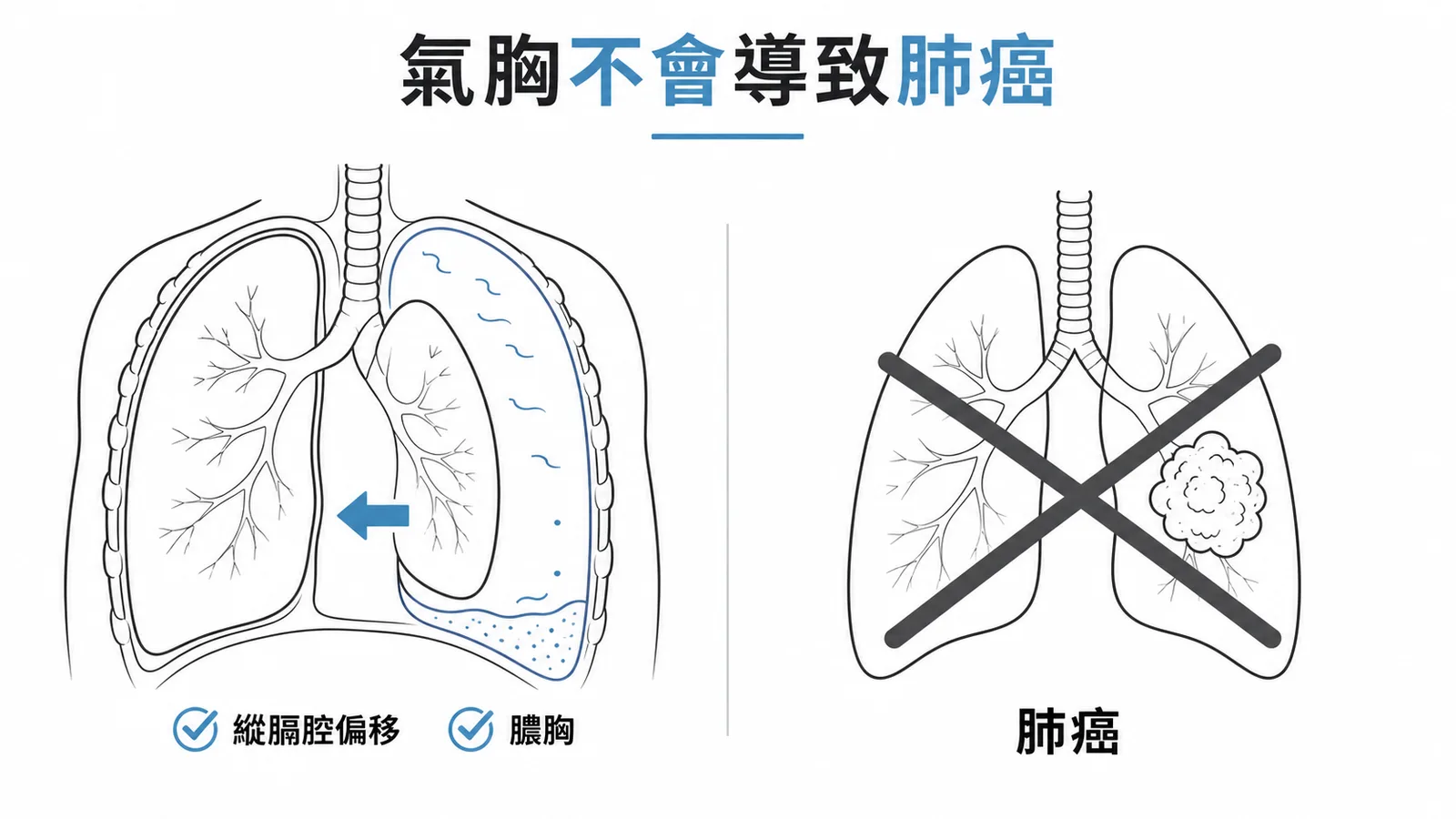 氣胸可能併發縱膈腔偏移和膿胸但不會導致肺癌的示意圖