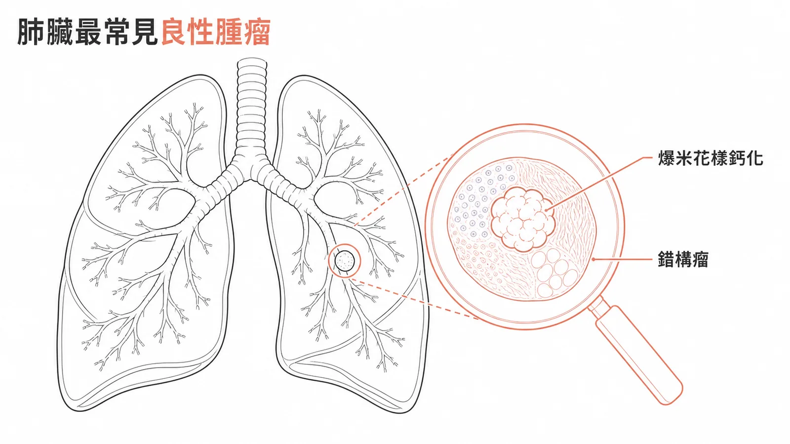 肺錯構瘤爆米花樣鈣化的示意圖