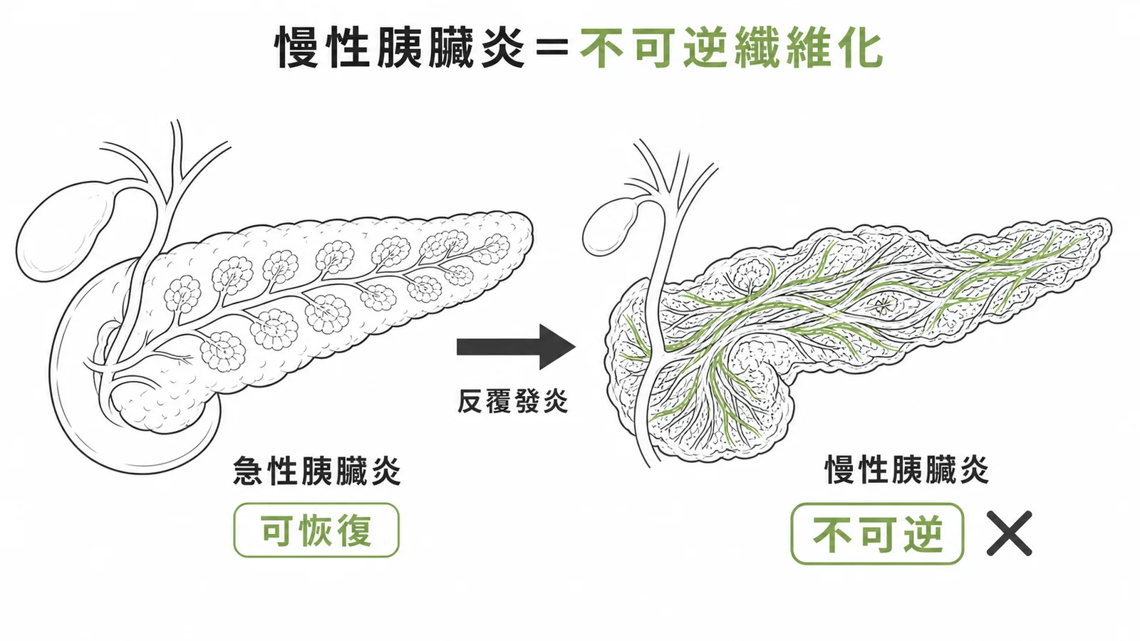 慢性胰臟炎不可逆纖維化：急性可恢復 vs 慢性不可逆