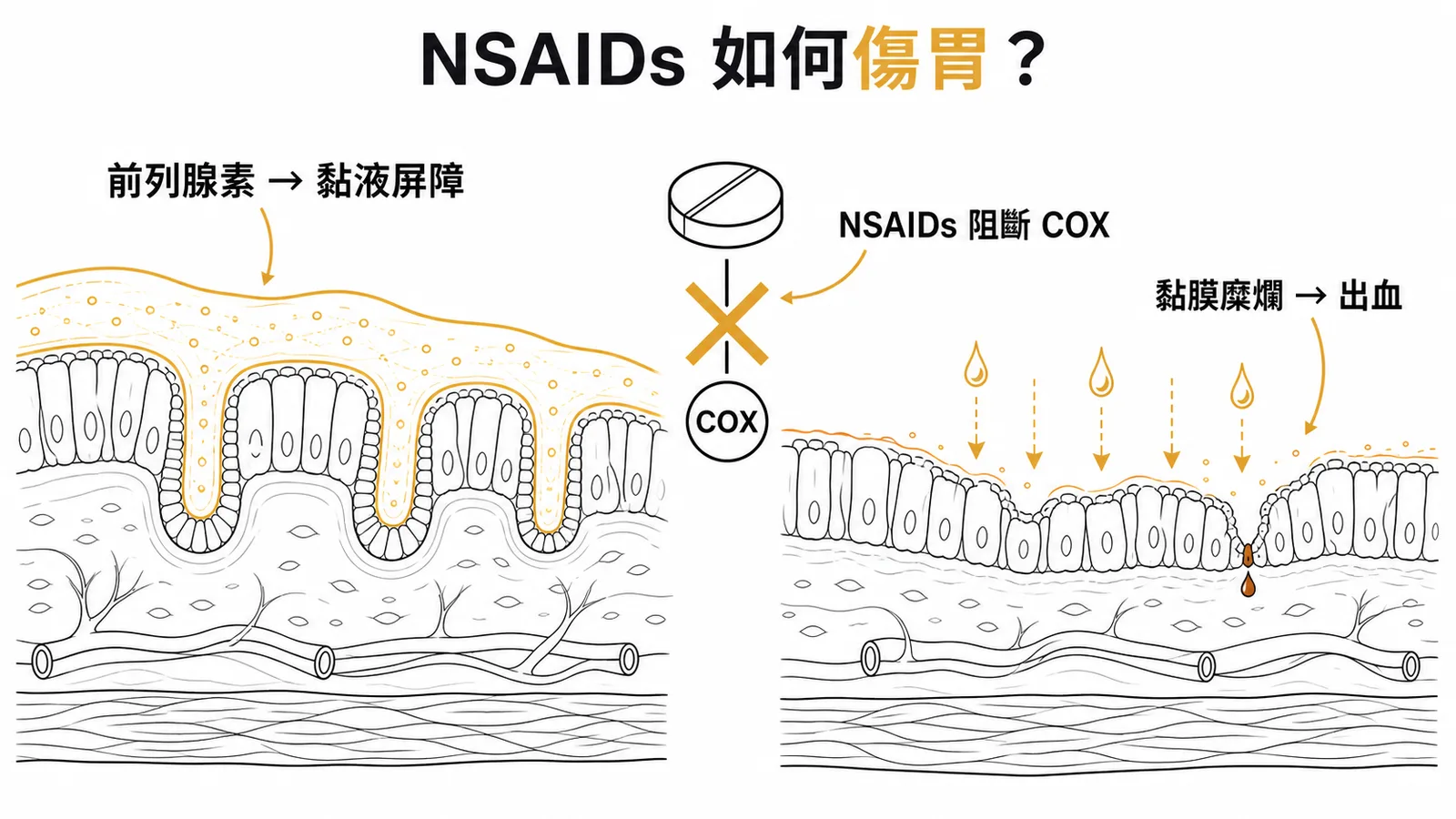 NSAIDs 阻斷 COX 破壞胃黏膜保護屏障導致糜爛出血