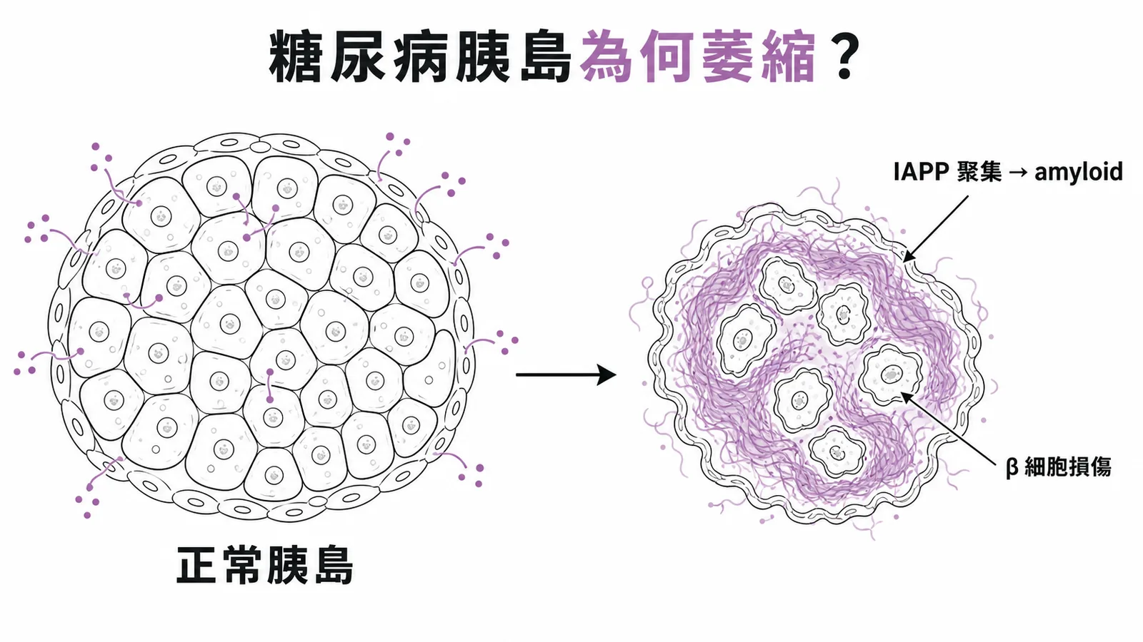 第二型糖尿病胰島 IAPP 聚集形成類澱粉沉積導致 β 細胞損傷