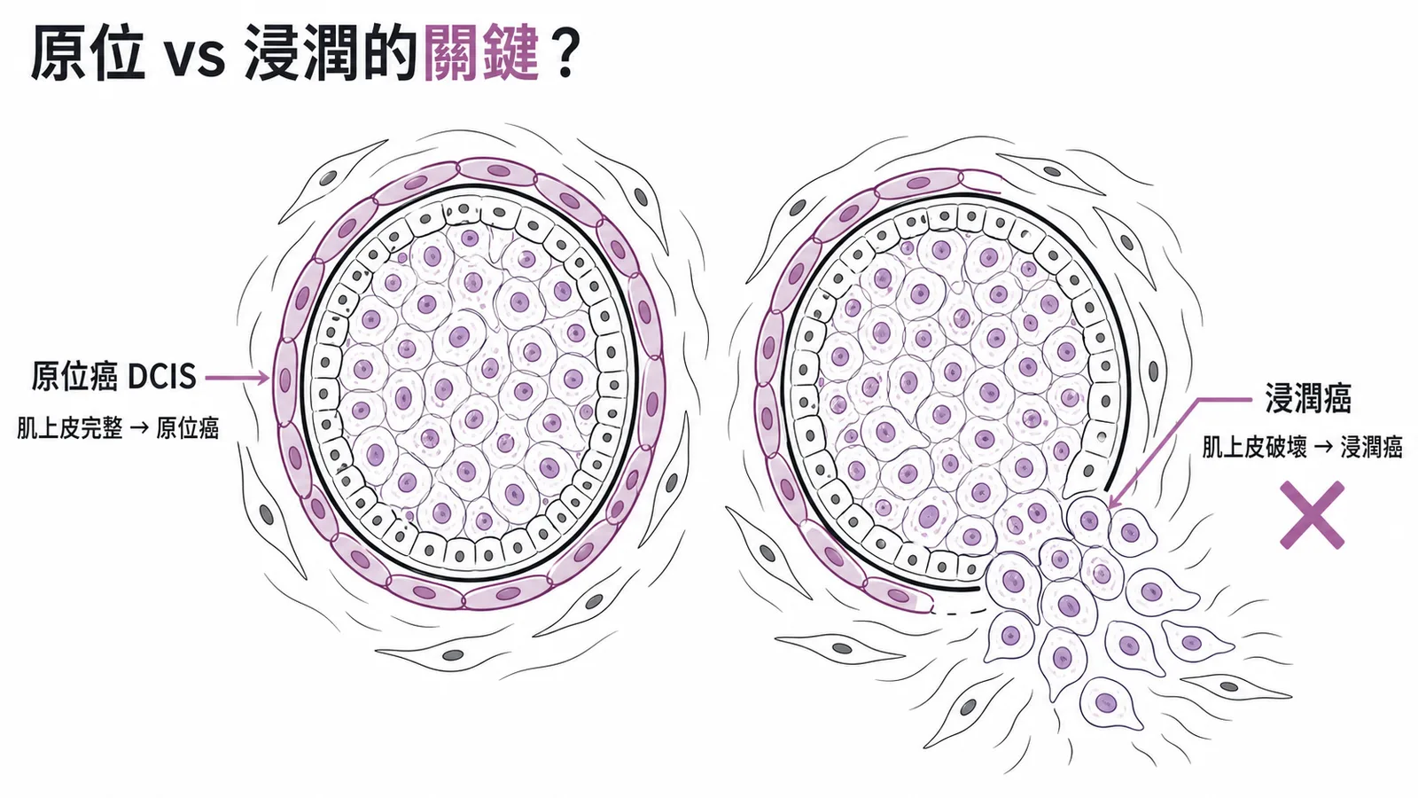 原位乳癌肌上皮完整 vs 浸潤癌肌上皮破壞