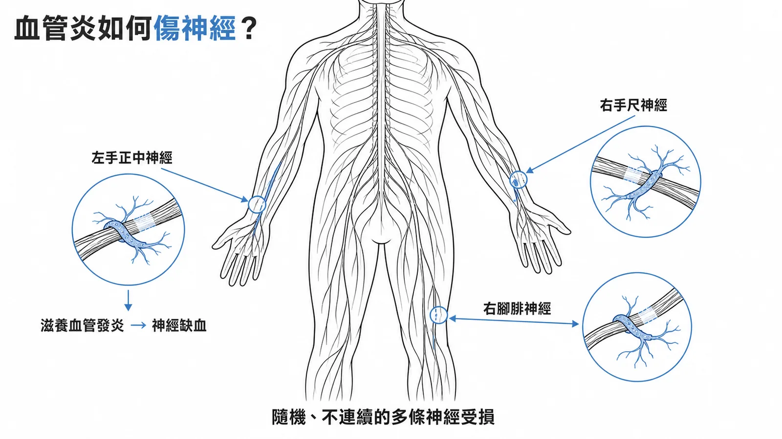 血管炎侵犯滋養血管導致多條不連續周邊神經缺血受損