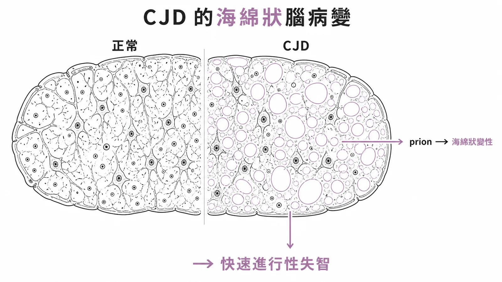 CJD 海綿狀腦病變：prion 導致腦組織空泡化與快速進行性失智