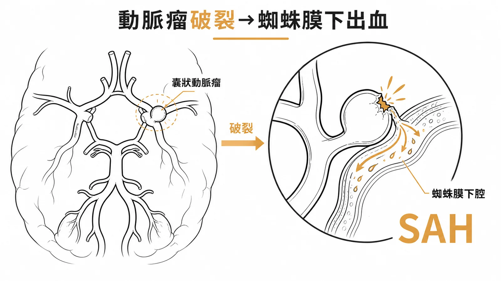 Willis 氏環囊狀動脈瘤破裂導致蜘蛛膜下腔出血 SAH
