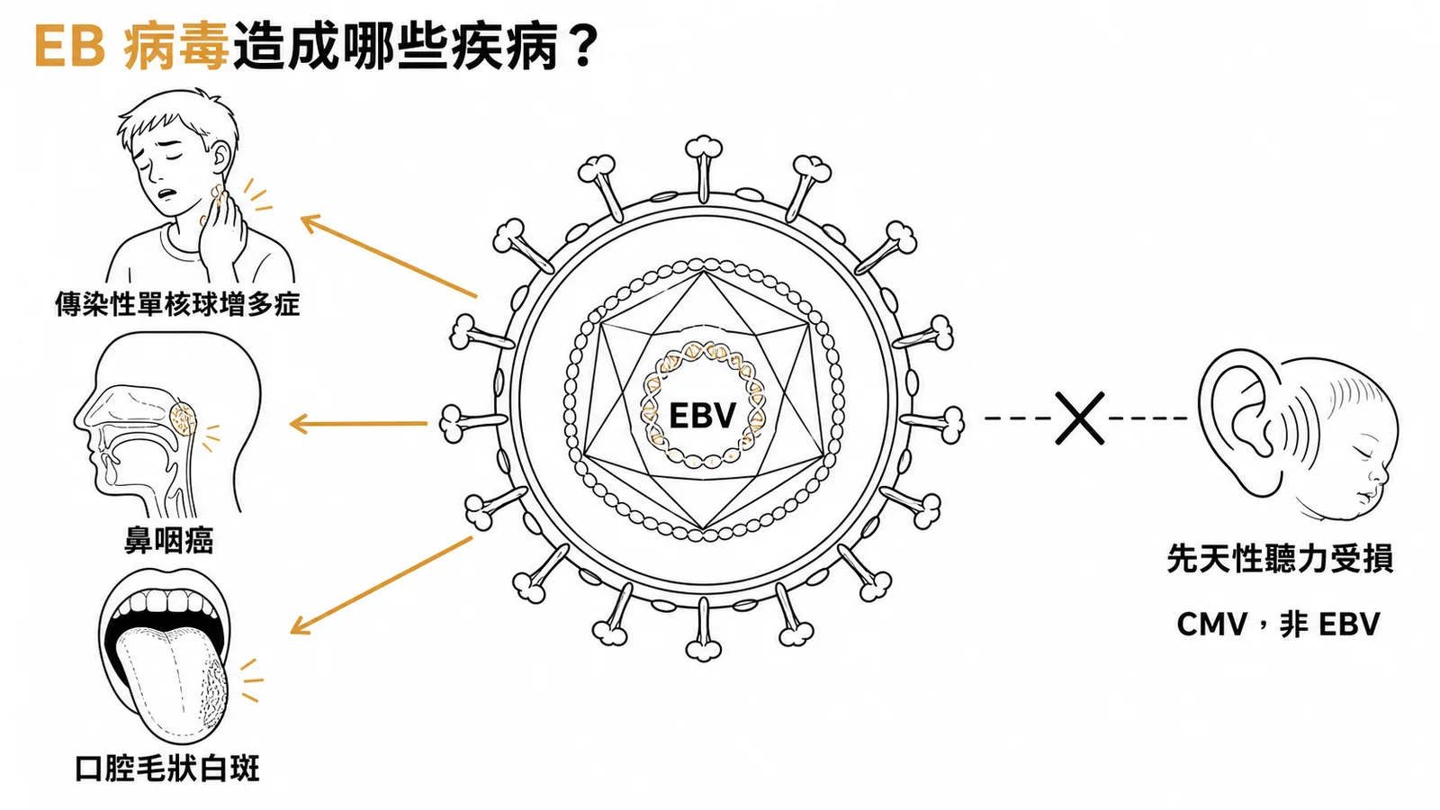 EBV相關疾病:單核球增多症、鼻咽癌、口腔毛狀白斑;先天性聽力受損是CMV非EBV