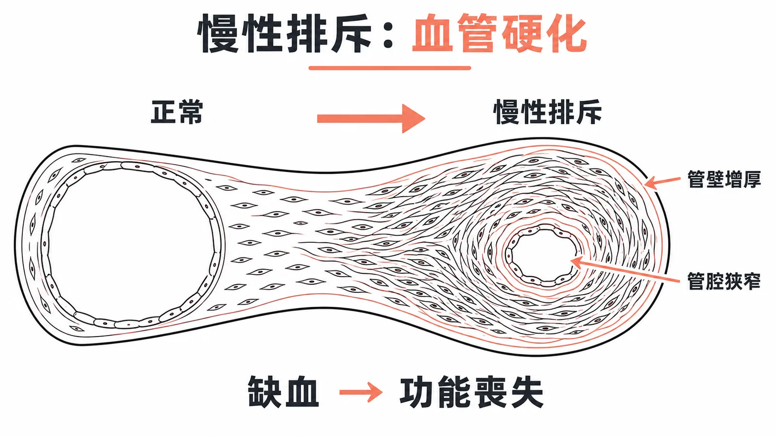 慢性排斥的核心病變:移植血管壁增厚、管腔狹窄導致缺血與功能喪失