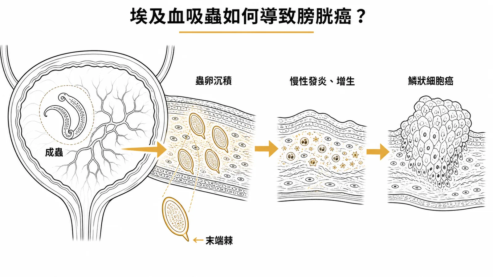 埃及血吸蟲致膀胱癌機轉:蟲卵沉積膀胱壁引發慢性發炎最終導致鱗狀細胞癌