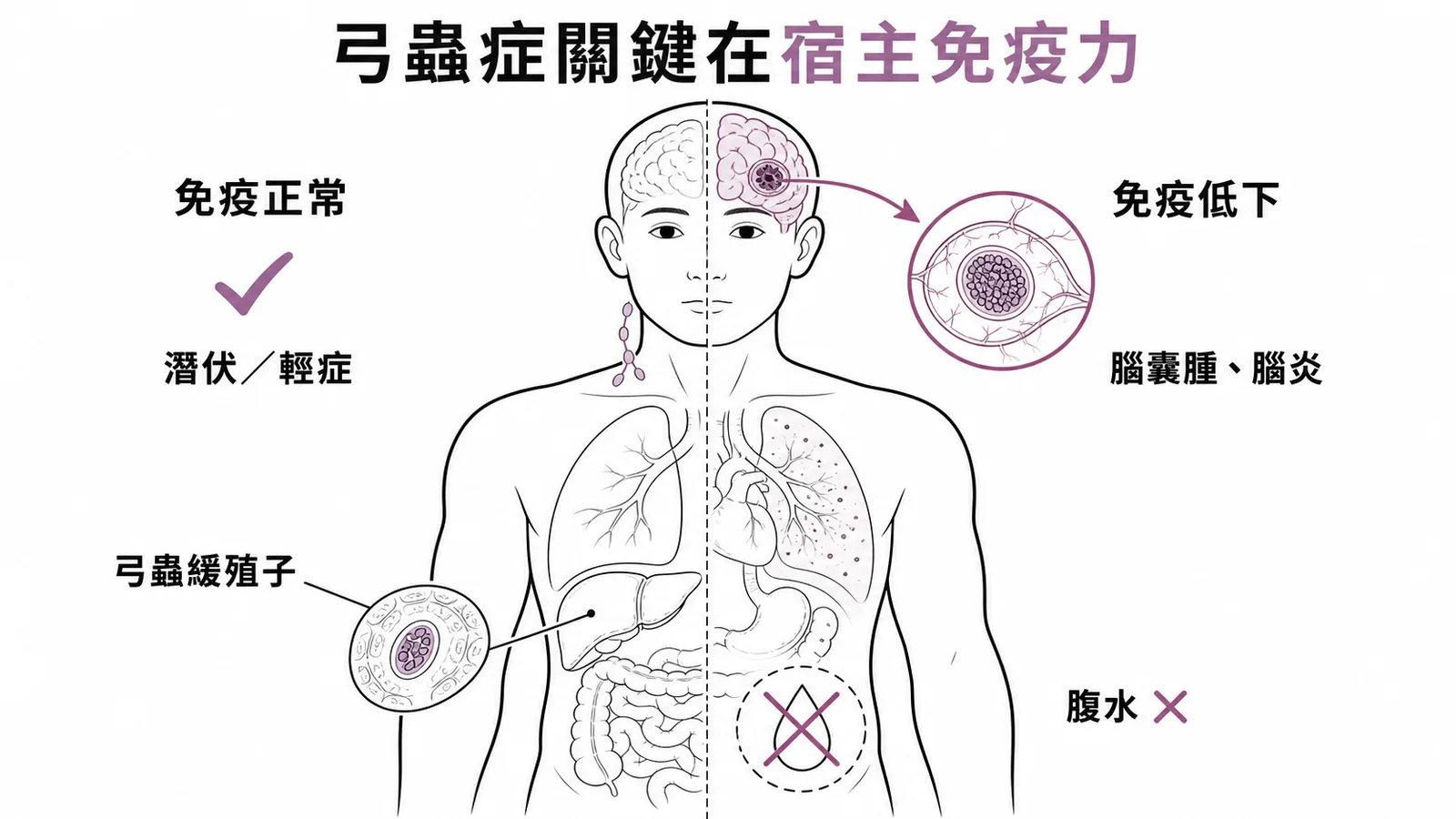 弓蟲症臨床結局取決於宿主免疫力:免疫正常潛伏輕症,免疫低下腦囊腫腦炎