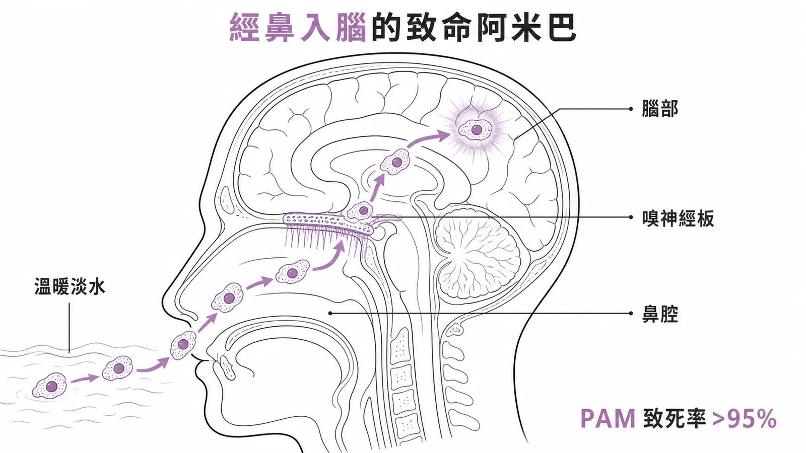 福氏內格里阿米巴經鼻腔穿過嗅神經板入侵腦部引起PAM的感染途徑
