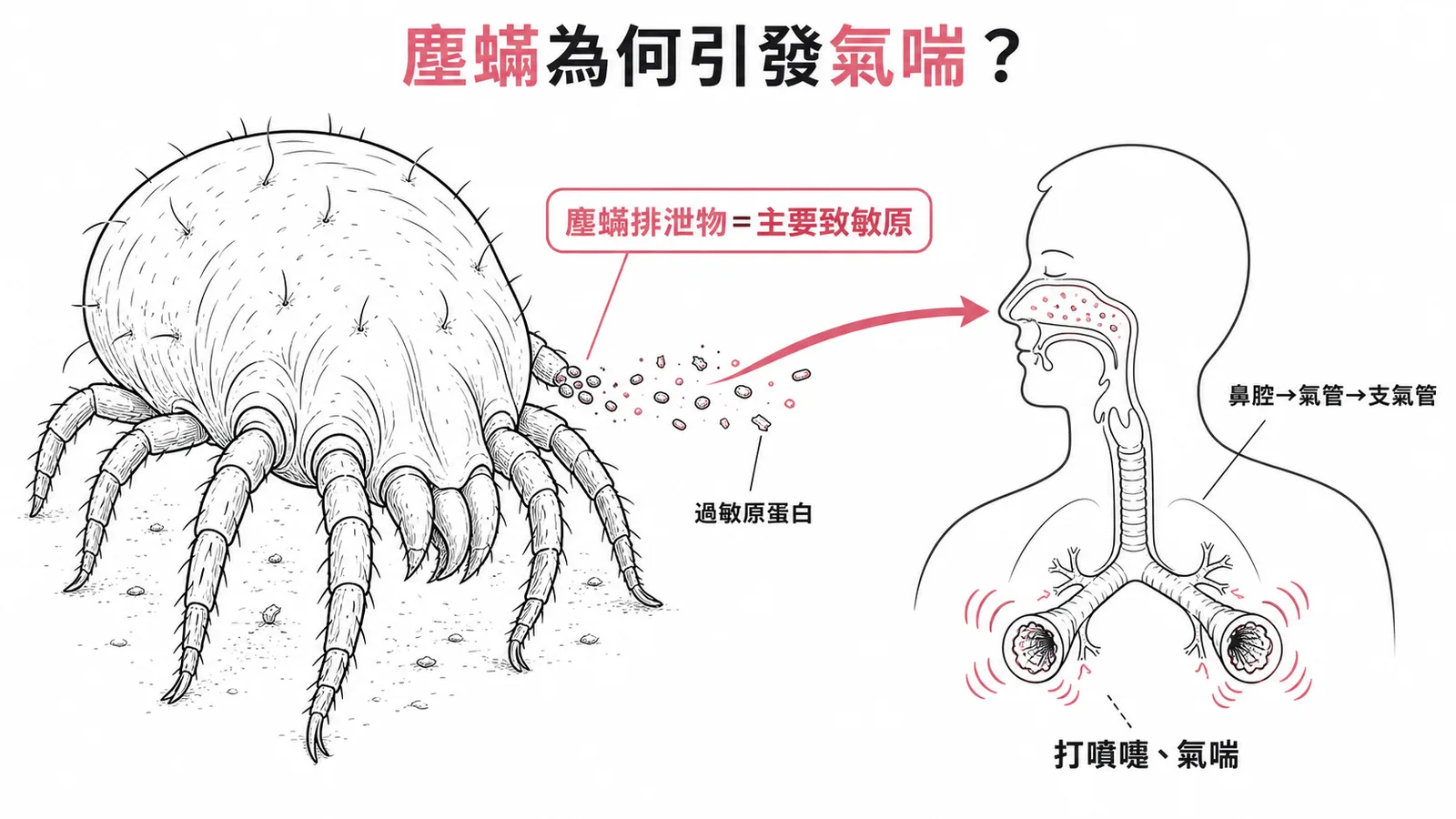 塵蟎排泄物作為主要致敏原經呼吸道引發氣喘的機轉