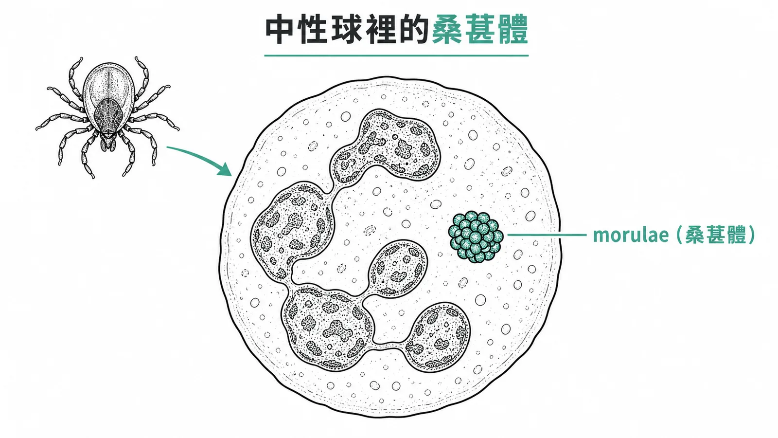 人艾利希體症診斷關鍵:蜱傳播後中性球內出現桑葚狀包涵體morulae