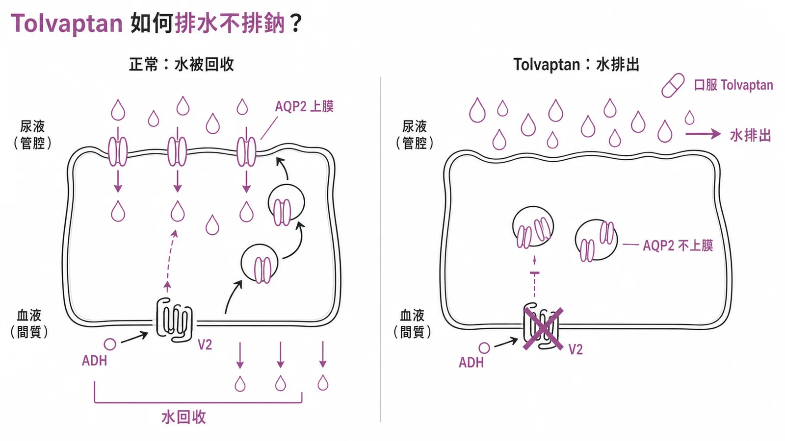 Tolvaptan 阻斷集尿管 V2 受體,AQP2 不上膜,水排出但不排鈉