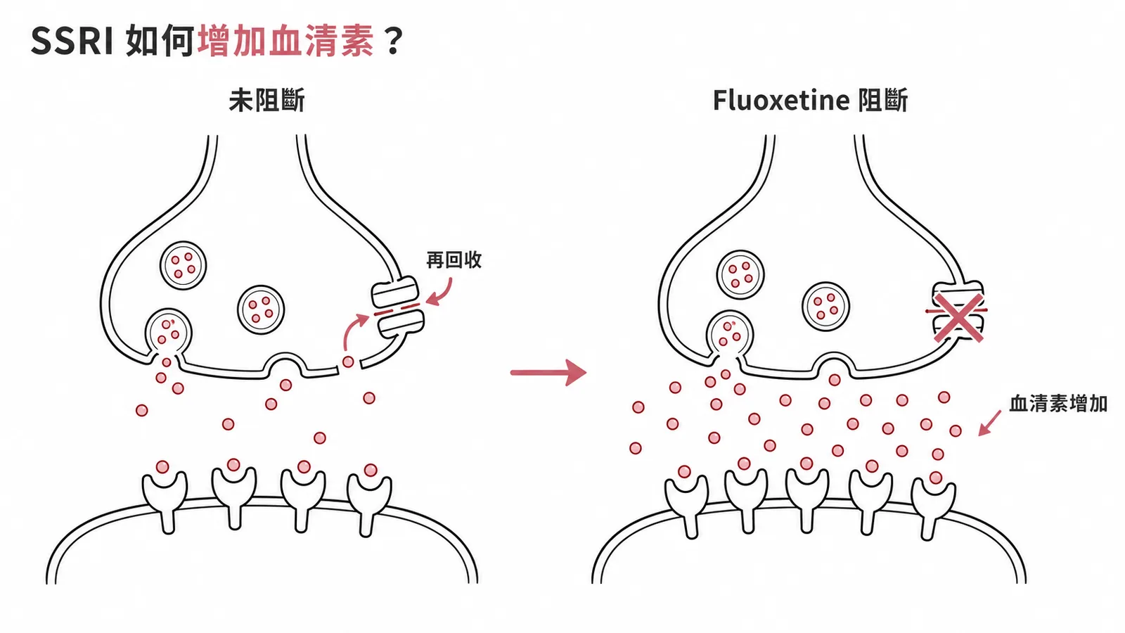 SSRI阻斷突觸前血清素再回收,使突觸間隙5-HT濃度上升
