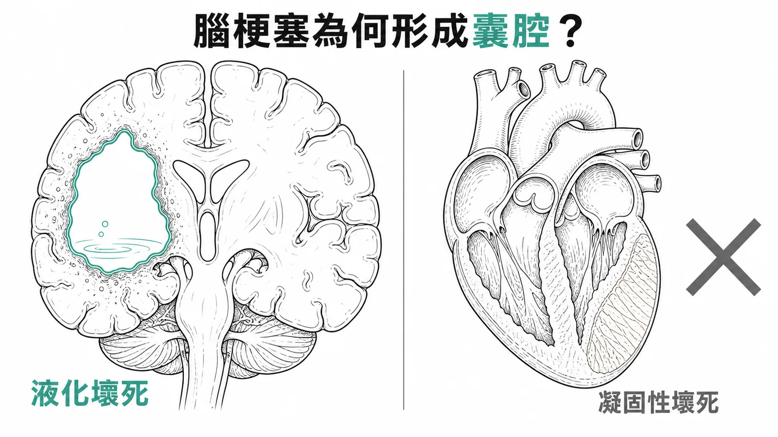 腦組織缺血後液化壞死形成囊腔，不同於心腎的凝固性壞死